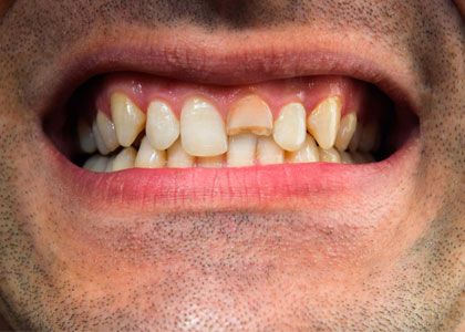 Damage-teeth-img