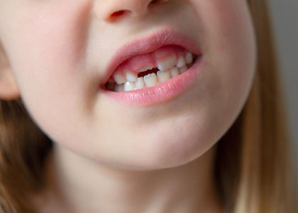 miss-tooth-img