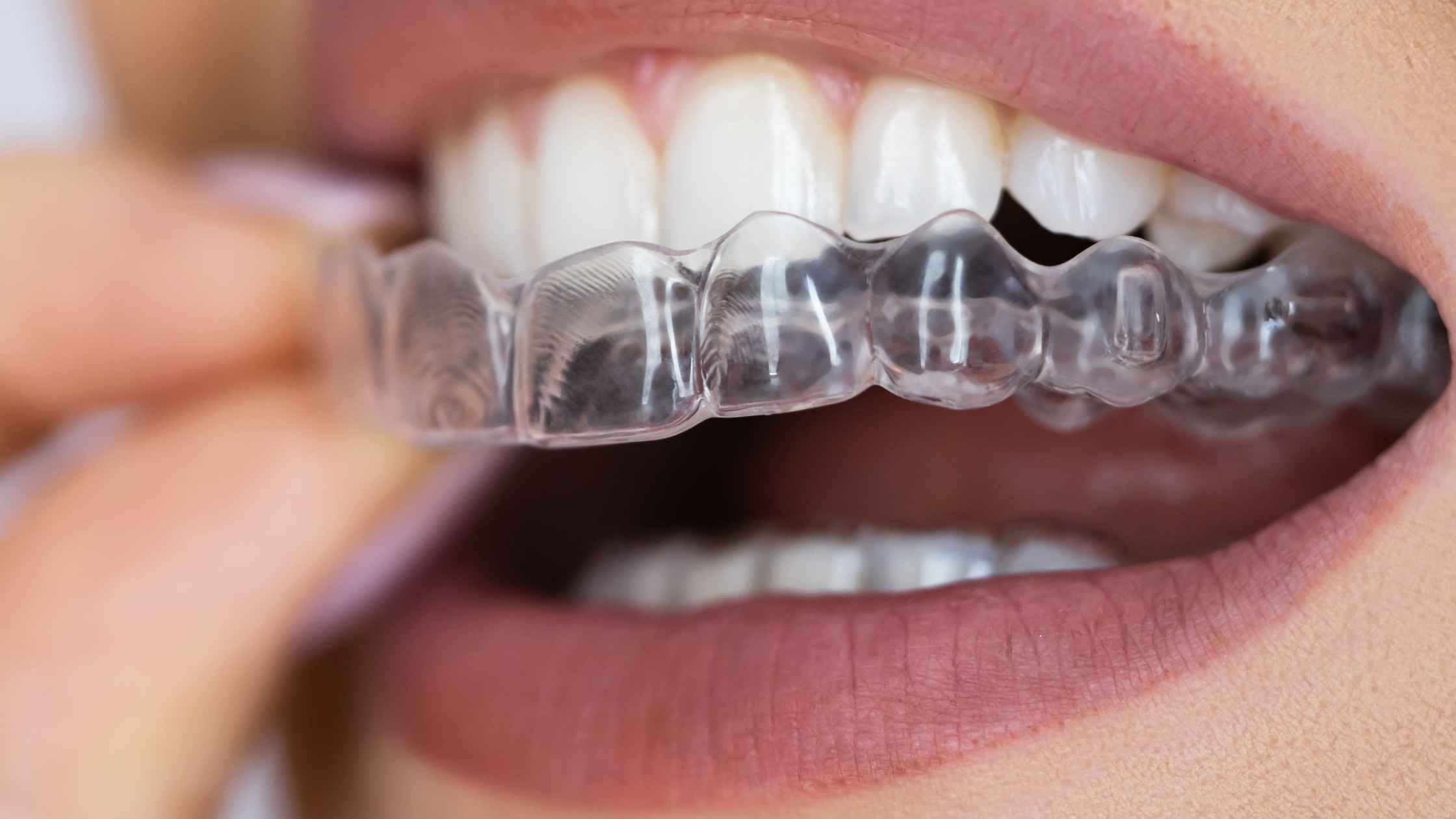 Person holding a clear aligner tray before wearing it to maintain proper oral hygiene and support teeth alignment.