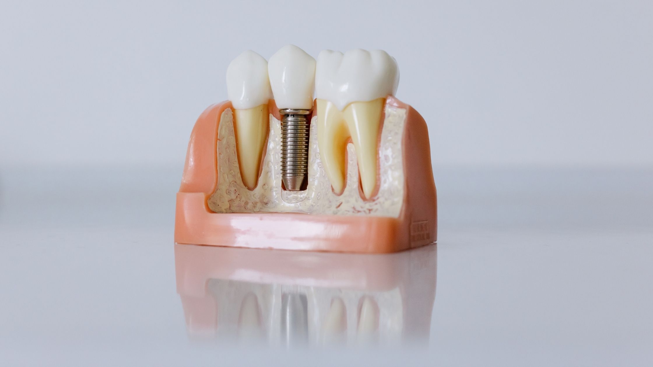 Dental implant placed in the jawbone between natural teeth