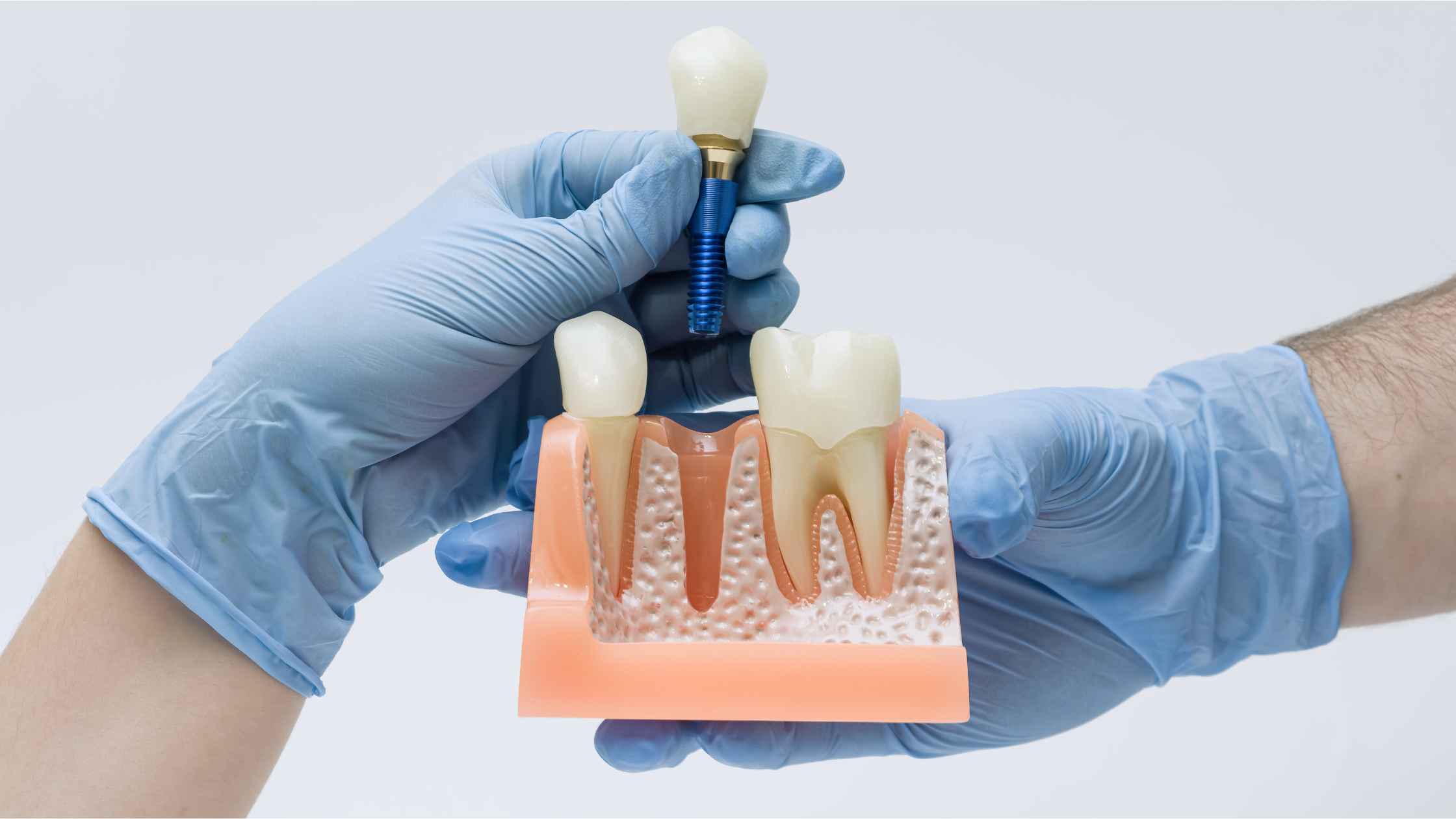 Dental implant placement model showing a missing tooth being replaced with a dental implant