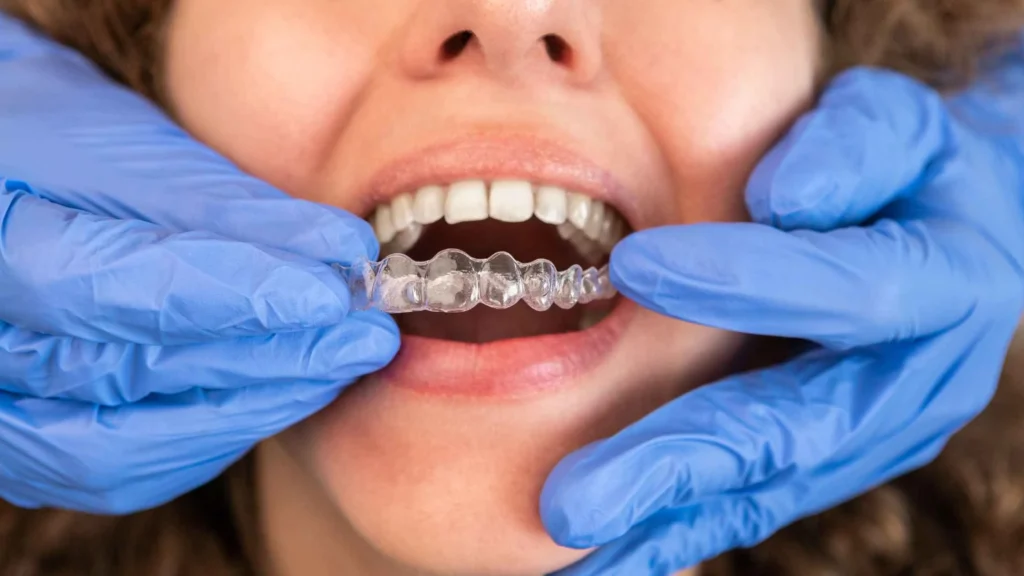 Top Clear Aligner Systems for Dental Clinics