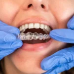 Top Clear Aligner Systems for Dental Clinics in India: A Clinician’s Guide