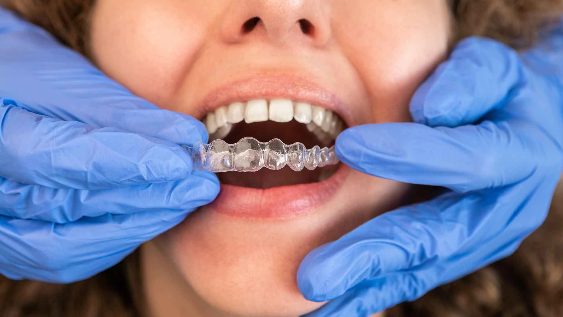Top Clear Aligner Systems for Dental Clinics